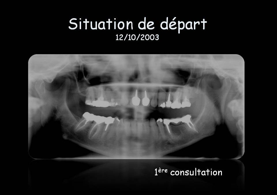 Reconstruction unilatérale terminale mandibulaire
